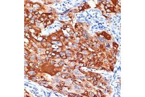 Immunohistochemistry of paraffin-embedded human lung cancer using IL13R Rabbit mAb (ABIN7267986) at dilution of 1:100 (40x lens). (IL13 Receptor alpha 1 Antikörper)