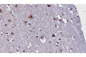 ABIN6275839 at 1/100 staining Human brain cancer tissue by IHC-P. (MATK Antikörper  (Internal Region))
