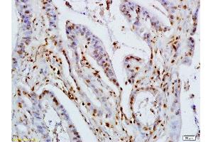 Formalin-fixed and paraffin embedded human colon carcinoma labeled with Rabbit Anti KLF4 Polyclonal Antibody, Unconjugated  at 1:200 followed by conjugation to the secondary antibody and DAB staining (KLF2/4 Antikörper  (AA 415-513))