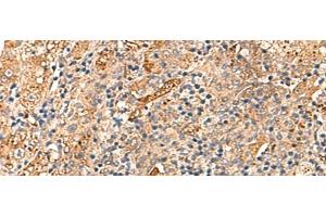Immunohistochemistry of paraffin-embedded Human liver cancer tissue using DNAJC14 Polyclonal Antibody at dilution of 1:70(x200) (DNAJC14 Antikörper)