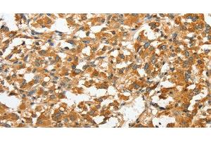 Immunohistochemistry of paraffin-embedded Human thyroid cancer tissue using ANXA9 Polyclonal Antibody at dilution 1:30 (Annexin A9 Antikörper)
