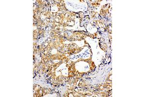 Anti-SDHC antibody, IHC(P) IHC(P): Human Gastric Cancer Tissue (SDHC Antikörper  (N-Term))