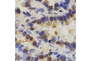 Immunohistochemical analysis of PAK2 staining in human lung cancer formalin fixed paraffin embedded tissue section. (PAK2 Antikörper)