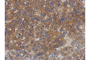 IHC-P Image Immunohistochemical analysis of paraffin-embedded human hepatoma, using GS2, antibody at 1:500 dilution. (PNPLA4 Antikörper)