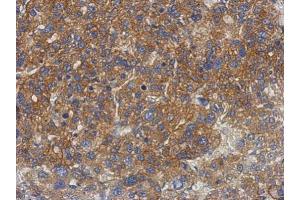 IHC-P Image Immunohistochemical analysis of paraffin-embedded human hepatoma, using GS2, antibody at 1:500 dilution.