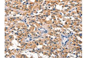 The image on the left is immunohistochemistry of paraffin-embedded Human thyroid cancer tissue using ABIN7190518(DUSP2 Antibody) at dilution 1/30, on the right is treated with synthetic peptide. (DUSP2 Antikörper)