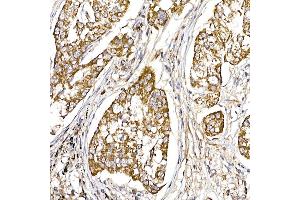 Immunohistochemistry of paraffin-embedded human lung cancer using UQCRH Rabbit mAb (ABIN7271126) at dilution of 1:50 (40x lens). (UQCRH Antikörper)