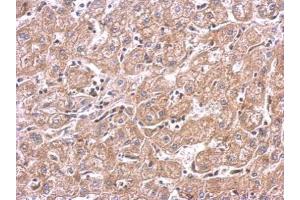 IHC-P Image mTOR antibody detects FRAP1 protein at cytosol on human hepatoma by immunohistochemical analysis. (MTOR Antikörper  (C-Term))