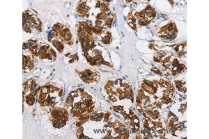 Immunohistochemistry of Human thyroid cancer using HINT2 Polyclonal Antibody at dilution of 1:50 (HINT2 Antikörper)