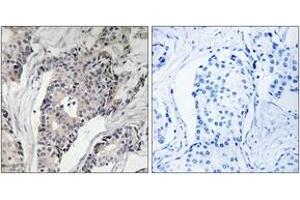 Immunohistochemistry analysis of paraffin-embedded human breast carcinoma, using THBS4 Antibody.