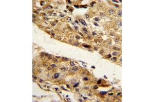 Formalin-fixed and paraffin-embedded human hepatocarcinoma reacted with SERPINF1 Antibody (N-term), which was peroxidase-conjugated to the secondary antibody, followed by DAB staining. (PEDF Antikörper  (N-Term))