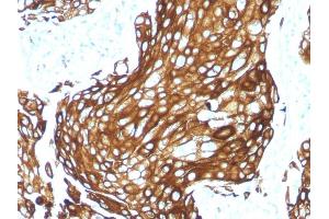 Formalin-fixed, paraffin-embedded human Lung Carcinoma stained with CK LMW Rabbit Recombinant Monoclonal Antibody (KRTL/1577R).