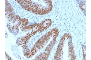 Formalin-fixed, paraffin-embedded human Colon Carcinoma stained with CDX2 Rabbit Recombinant Monoclonal Antibody (CDX2/2951R). (Rekombinanter CDX2 Antikörper  (AA 150-249))