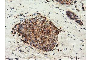Immunohistochemical staining of paraffin-embedded Adenocarcinoma of Human breast tissue using anti-CLPP mouse monoclonal antibody. (CLPP Antikörper)
