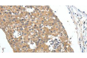 Immunohistochemistry of paraffin-embedded Human breast cancer tissue using FSHR Polyclonal Antibody at dilution 1:70 (FSHR Antikörper)