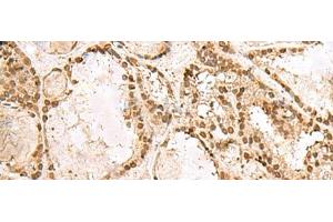 Immunohistochemistry of paraffin-embedded Human thyroid cancer tissue using KRR1 Polyclonal Antibody at dilution of 1:50(x200) (KRR1 Antikörper)