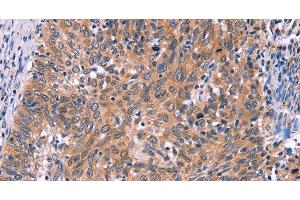 Immunohistochemistry of paraffin-embedded Human cervical cancer tissue using EDN1 Polyclonal Antibody at dilution 1:50 (Endothelin 1 Antikörper)