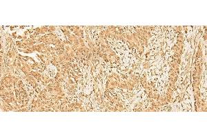 Immunohistochemistry of paraffin-embedded Human ovarian cancer tissue using ZNF471 Polyclonal Antibody at dilution of 1:50(x200)