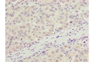 Immunohistochemistry of paraffin-embedded human liver cancer using ABIN7166405 at dilution of 1:100 (ARMT1 (AA 2-250) Antikörper)