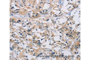 Immunohistochemistry of Human thyroid cancer using IL17RB Polyclonal Antibody at dilution of 1:40