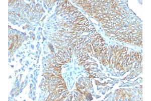 Formalin-fixed, paraffin-embedded human Esophageal carcinoma stained with TRIM29 Mouse Monoclonal Antibody (TRIM29/1041). (TRIM29 Antikörper  (AA 1-200))