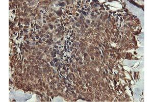 Immunohistochemical staining of paraffin-embedded Adenocarcinoma of Human breast tissue using anti-AKT1 mouse monoclonal antibody. (AKT1 Antikörper)