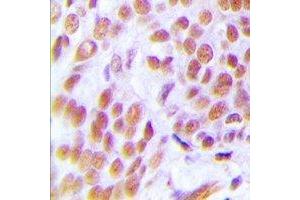 Immunohistochemical analysis of ZNF265 staining in human breast cancer formalin fixed paraffin embedded tissue section. (ZNF265 Antikörper)