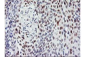 Immunohistochemical staining of paraffin-embedded Carcinoma of Human bladder tissue using anti-BACH1 mouse monoclonal antibody.