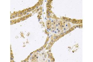Immunohistochemistry of paraffin-embedded Human thyroid cancer using FHL1 Polyclonal Antibody at dilution of 1:100 (40x lens). (FHL1 Antikörper)