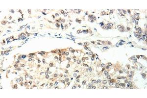 Immunohistochemistry of paraffin-embedded Human breast cancer using TPM2 Polyclonal Antibody at dilution of 1:60 (TPM2 Antikörper)