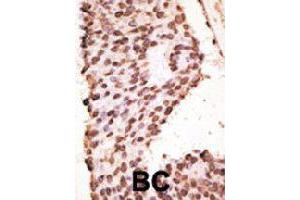 Formalin-fixed and paraffin-embedded human cancer tissue reacted with MMP7 polyclonal antibody  , which was peroxidase-conjugated to the secondary antibody, followed by AEC staining.