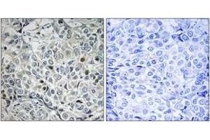 Immunohistochemistry analysis of paraffin-embedded human breast carcinoma, using USP53 Antibody. (USP53 Antikörper  (AA 951-1000))