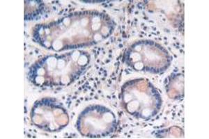 IHC-P analysis of Human Stomach Cancer Tissue, with DAB staining. (ATP6AP2 Antikörper  (AA 17-302))