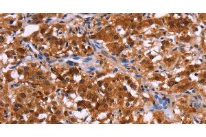 Immunohistochemistry of paraffin-embedded Human thyroid cancer tissue using USP2 Polyclonal Antibody at dilution 1:40 (USP2 Antikörper)