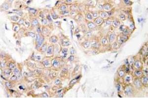 Immunohistochemistry analysis of CD213a1 / IL13RA1 Antibody in paraffin-embedded human breast carcinoma tissue. (IL13 Receptor alpha 1 Antikörper)