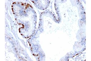 Formalin-fixed, paraffin-embedded human Prostate Carcinoma stained with Cystatin A Mouse Monoclonal Antibody (CPTC-CSTA-1). (CSTA Antikörper)