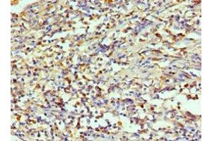 Immunohistochemistry of paraffin-embedded human cervical cancer using ABIN7143994 at dilution of 1:100 (AIMP1 Antikörper  (AA 25-180))