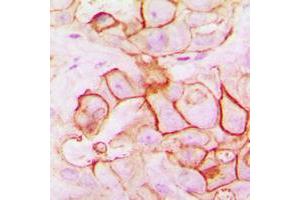 Immunohistochemical analysis of PMEPA1 staining in human breast cancer formalin fixed paraffin embedded tissue section. (PMEPA1 Antikörper  (Center))