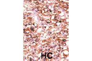 Formalin-fixed and paraffin-embedded human hepatocellular carcinoma tissue reacted with ACVR2B polyclonal antibody  , which was peroxidase-conjugated to the secondary antibody, followed by AEC staining.