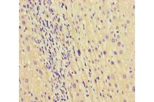 Immunohistochemistry of paraffin-embedded human liver cancer using ABIN7168865 at dilution of 1:100 (Septin 2 Antikörper  (AA 1-361))