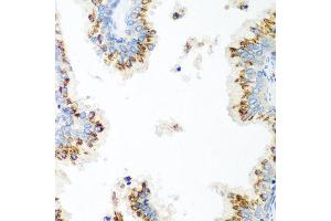 Immunohistochemistry of paraffin-embedded human prostate using UBIAD1 antibody at dilution of 1:100 (40x lens). (UBIAD1 Antikörper)