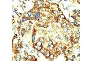 IHC analysis of FFPE human hepatocarcinoma stained with the Dnmt2 antibody (Dnmt2 Antikörper  (AA 346-375))