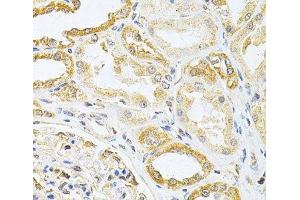 Immunohistochemistry of paraffin-embedded Human kidney cancer using VAPB Polyclonal Antibody at dilution of 1:200 (40x lens). (VAPB Antikörper)