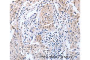 Immunohistochemistry of Human lung cancer using APEX1 Polyclonal Antibody at dilution of 1:20 (APEX1 Antikörper)