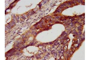 IHC image of ABIN7146237 diluted at 1:400 and staining in paraffin-embedded human colon cancer performed on a Leica BondTM system. (Cadherin 7 Antikörper  (AA 146-296))