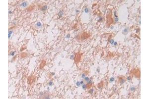 DAB staining on IHC-P; Samples: Human Glioma Tissue (VWA3A Antikörper  (AA 981-1176))