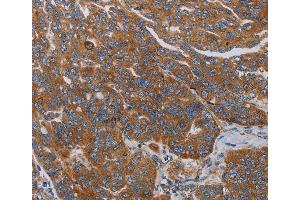 Immunohistochemistry of Human cervical cancer using PARP10 Polyclonal Antibody at dilution of 1:30 (PARP10 Antikörper)