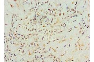 Immunohistochemistry of paraffin-embedded human breast cancer using ABIN7144316 at dilution of 1:100 (AGR2 Antikörper  (AA 21-175))