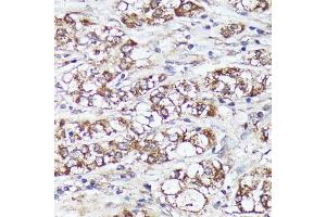 Immunohistochemistry of paraffin-embedded human liver cancer using MTHFD2 antibody (ABIN6132367, ABIN6144144, ABIN6144145 and ABIN6214625) at dilution of 1:100 (40x lens).