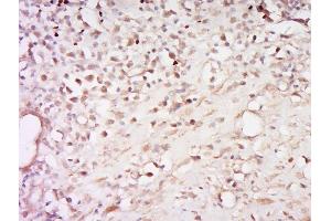 Paraformaldehyde-fixed, paraffin embedded human cervical cancer, Antigen retrieval by boiling in sodium citrate buffer (pH6) for 15min, Block endogenous peroxidase by 3% hydrogen peroxide for 30 minutes, Blocking buffer (normal goat serum) at 37°C for 20min, Antibody incubation with Glucocorticoid Receptor (S226) Antibody, Unconjugated  at 1:200 overnight at 4°C, followed by a conjugated secondary and DAB staining. (Glucocorticoid Receptor Antikörper  (pSer226))